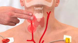 Carotid Sinus Massage 2017 [upl. by Anadroj477]