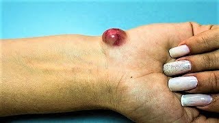 How To Get Rid Of Ganglion Cysts [upl. by Eimot]