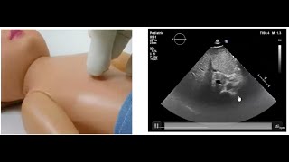 Basics of Pediatric Echocardiography Determining the Situs by Dr Gaurav Agrawal [upl. by Anairo63]