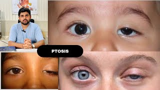 Ptosis and its classification drhashimjabbar education optometry eye ptosis [upl. by Kassel]