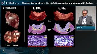 EHRA Congress 2024 Highdefinition mapping and ablation [upl. by Vander684]