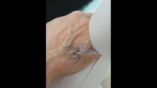 Tattoo Removal With The Q Switched NdYAG  Lumenis [upl. by Rabiah]