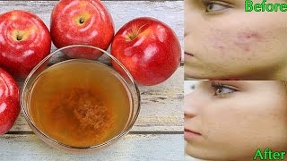 What Will Happen If You Drink Apple Cider Vinegar Daily [upl. by Enorel]