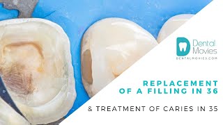 Replacement of a filling in 36 amp treatment of caries in 35 [upl. by Ecnav211]