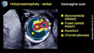 Holoprosencephaly alobar [upl. by Cynara]