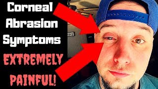 Corneal Abrasion Symptoms amp Treatment  My Ongoing Painful Situation [upl. by Beitch]