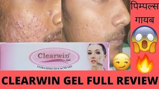 Clearwin gel uses in hindi  clearwin gel for pimple whitehead blackheads clearwin gel pimple quotCLCquot [upl. by Alta]