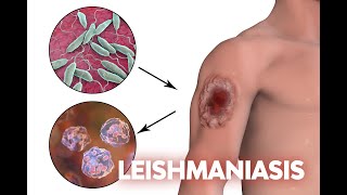 Las leishmaniasis son enfermedades endémicas que afectan al noroeste argentino [upl. by Iglesias]