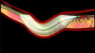 Balloon Angioplasty and Stenting Animation [upl. by Hild]