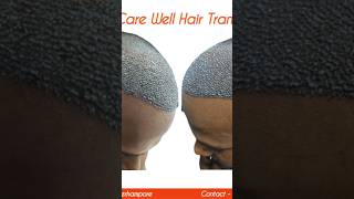 haircare hairlossttreatment besthairtransplantresults hairtransplantclinic hairtransplant [upl. by Noryt]