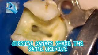 can lower Second Molar be 2 Canals Only [upl. by Kermy]