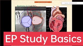 AF Ablation 2 Groin Puncture amp Catheter Positioning [upl. by Normand311]