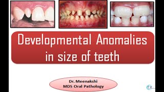 Developmental disturbances in Size of teeth [upl. by Colinson]