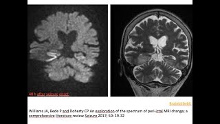 74 Postictal imaging changes excitotoxic edema hyperperfusion BBB disruption seizure related [upl. by Vilma]