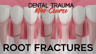 Dental Trauma MiniCourse  Part 6  Dental Trauma Guide  Root Fractures [upl. by Erminie117]