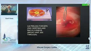 Annual Conference 2023  Macular Surgery Updates Keynote Lecture  Prof Sherif Sheta [upl. by Pacheco]