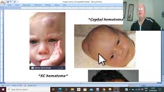 Trauma in Arabic 7 Scalp Haematoma  by Dr Wahdan [upl. by Mighell868]