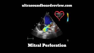 Mitral Valve Perforation Echocardiography [upl. by Hannahc]