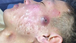 Big Cystic Acne Blackheads Extraction Blackheads amp Milia Whiteheads Removal Pimple Popping  2366 [upl. by Aracahs]