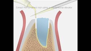 DIT Fractured tooth extraction [upl. by Srednas]