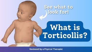 What is Torticollis [upl. by Ecilahs]