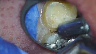 Full metal crown preparation for upper right molar [upl. by Aduhey]