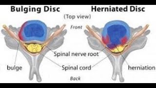 Disc Herniation vs Disc Bulge [upl. by Anileuqcaj785]