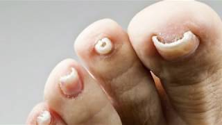 How Excilor Fungal Nail Treatment works  Now in UK [upl. by Rafaela]