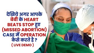 Missed Miscarriage क्यों होता है देखिए Live Operation और D and C प्रक्रिया  Dr Asha Gavade [upl. by Roeser]