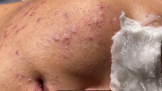 Blackheads amp Whiteheads Pore Removal New 2024  Acne Treatment With Bo Nguyễn Spa [upl. by Langsdon]