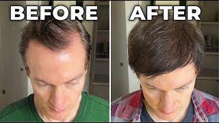 How I Reversed My Hair Loss  Greying [upl. by Hastings796]