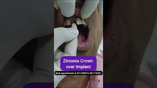 Zirconia Crowns over Implant Dr Srishti Bhatia smilemakeover [upl. by Asillam505]