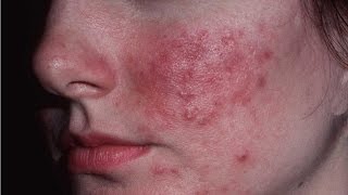 Home Remedies for rosacea  Red Face  How to get rid of Rosacea [upl. by Bernhard]