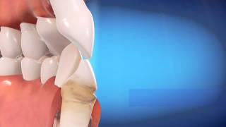 Invisalign Educational Video [upl. by Oremor]