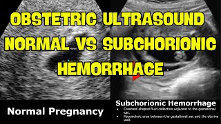 Obstetric Ultrasound Normal Vs Subchorionic Hemorrhage SCH  Early amp Mid Pregnancy Bleeding USG [upl. by Ytineres101]