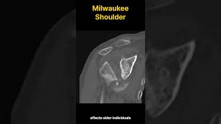 Milwaukee Shoulder Syndrome  Destructive Shoulder Arthropathy 밀워키 어깨 증후군 파괴적인 어깨 관절염 [upl. by Jaquelin]