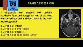 BRAIN ABSCESS [upl. by Redienhcs]