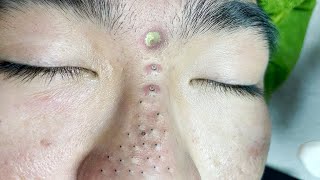 Big Cystic Acne Blackheads Extraction Blackheads amp Milia Whiteheads Removal Pimple Popping  5186 [upl. by Winola]