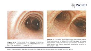 Broncoscopía [upl. by Azral]