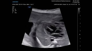 TETRALOGY OF FALLOT FETAL ECHO ULTRASOUND [upl. by Beverlie]