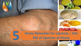 5 Home Remedies for Lipomas  Get Rid of Lipomas at Home [upl. by Nnylav659]