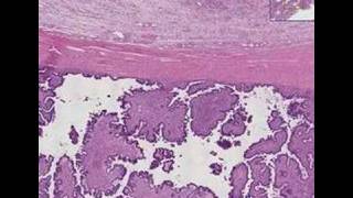 Histopathology OvaryBorderline ovarian tumor [upl. by Kcarb709]