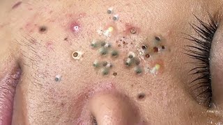 Big Cystic Acne Blackheads Extraction Blackheads amp Milia Whiteheads Removal Pimple Popping  4425 [upl. by Noemad680]