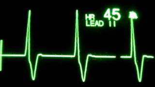 Accelerated Ventricular Rhythm AVR [upl. by Husain]