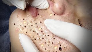 Big Cystic Acne Blackheads Extraction Blackheads amp Milia Whiteheads Removal Pimple Popping  3527 [upl. by Odnanreh699]