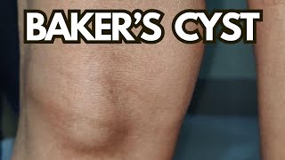 Bakers Cyst Explained What You MUST Know About Knee Pain Relief [upl. by Rosena637]