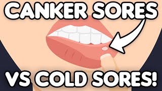 Cold Sores VS Canker Sores [upl. by Latsyrcal]