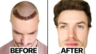 My Hair Transplant Results 6 Months  Surgeon Reacts [upl. by Poyssick]