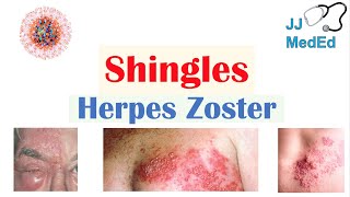 Shingles Herpes Zoster Pathophysiology Risk Factors Phases of Infection Symptoms Treatment [upl. by Rotman166]