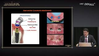 PROSTHODONTICS Clinical Application of Implant Overdenture Using Locator Attachment [upl. by Liesa]